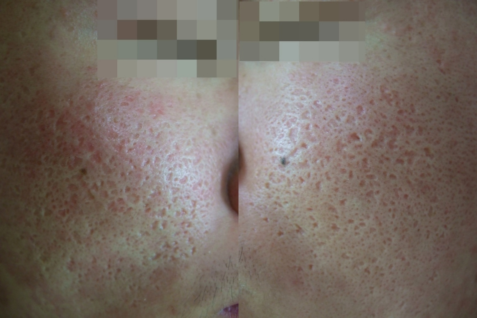광주여드름흉터치료 전 양볼 패임