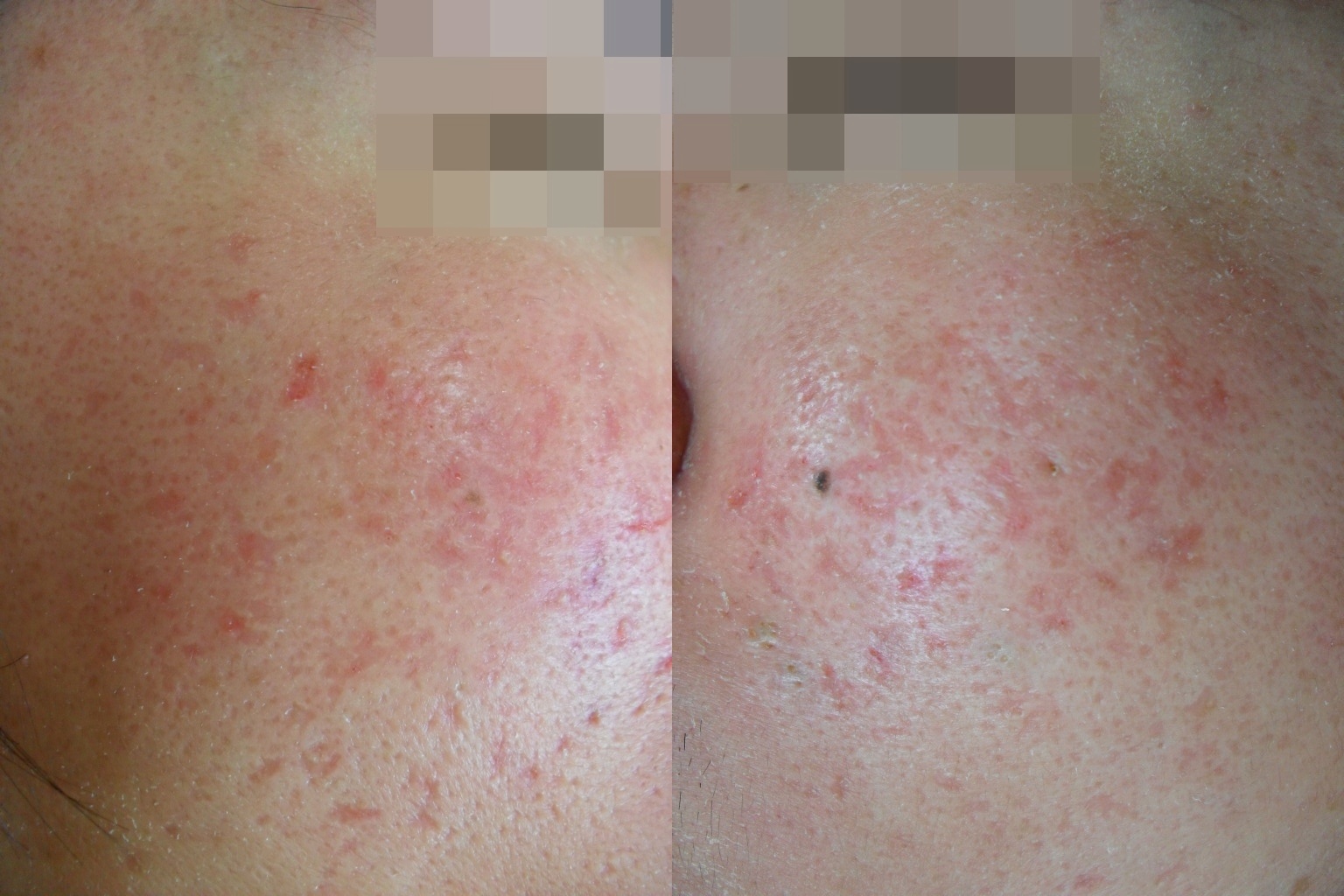 광주여드름흉터치료 패임과 붉은 홍조가 같이 있는 모습