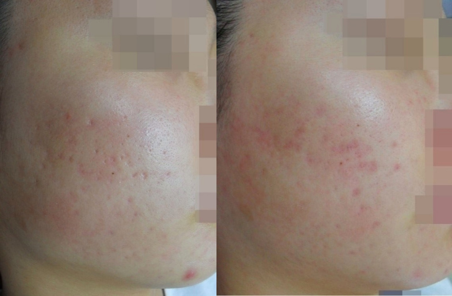 광주여드름흉터치료 후 평평해진 피부결