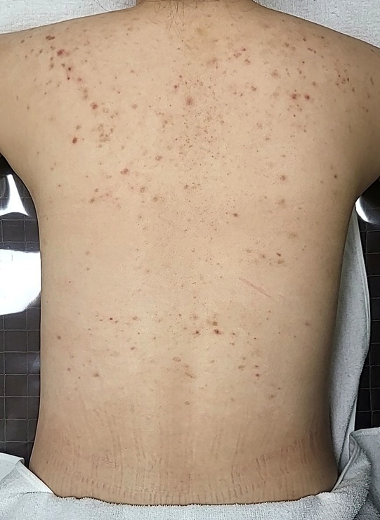 광주등여드름치료 전 전체적으로 심한 상태