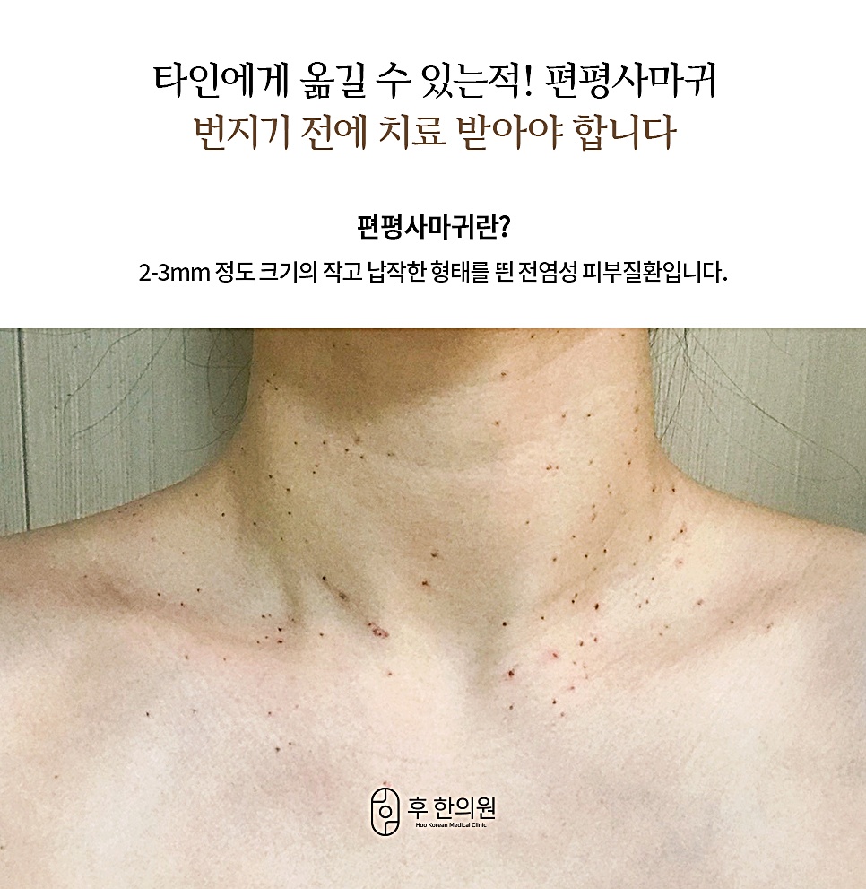 편평사마귀는 방치 시 타인에게 옮을 수 있는 전염성 피부질환