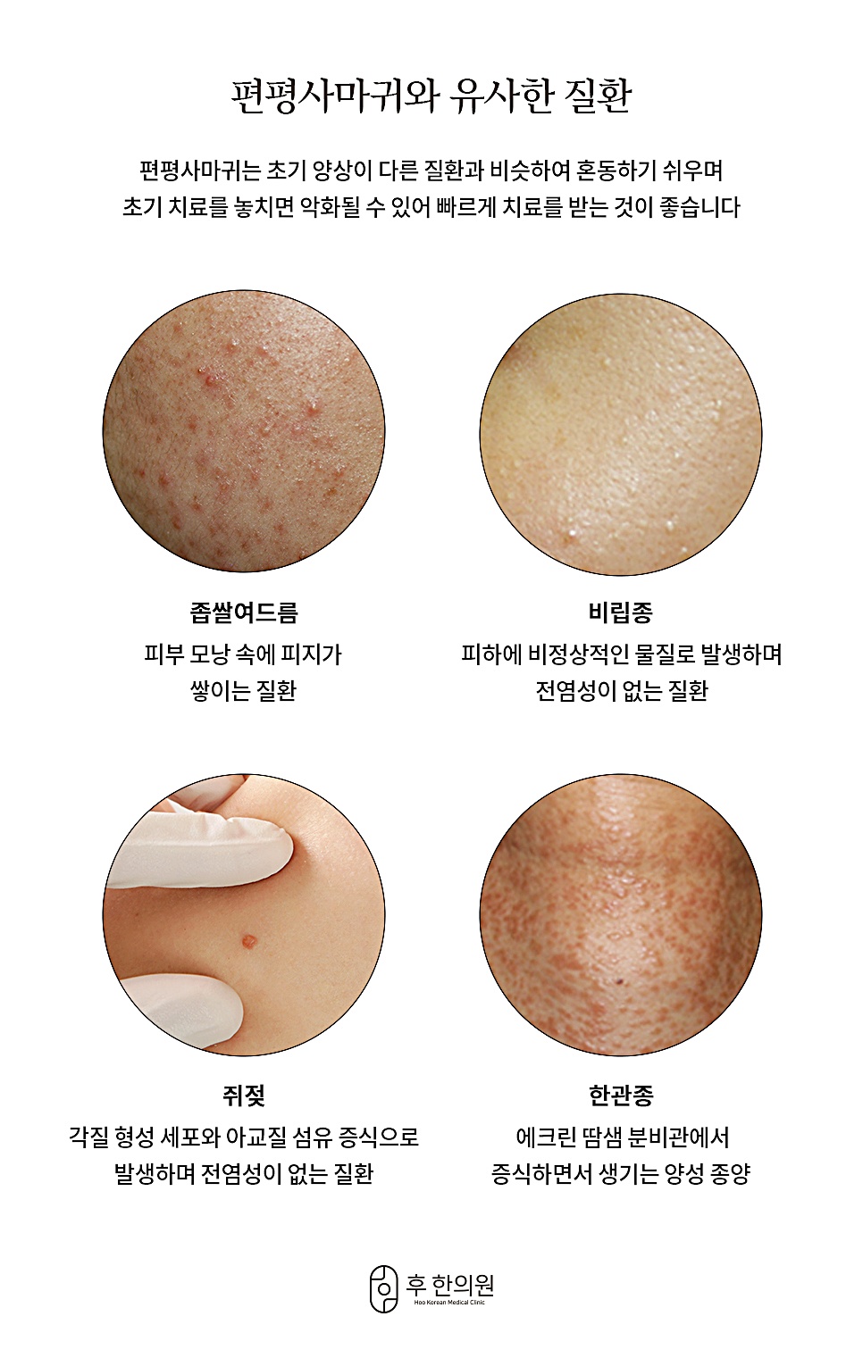 편평사마귀와 헷갈리기 쉬운 질환 비교 이미지, 좁쌀여드름·비립종·쥐젖·한관종의 특징 설명