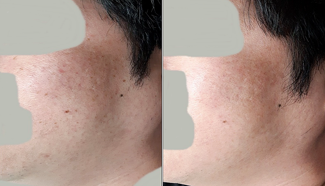 편평사마귀 치료 전후 비교, 턱선에서 목 옆쪽 부위에 있던 편평사마귀가 치료 후 정리된 모습