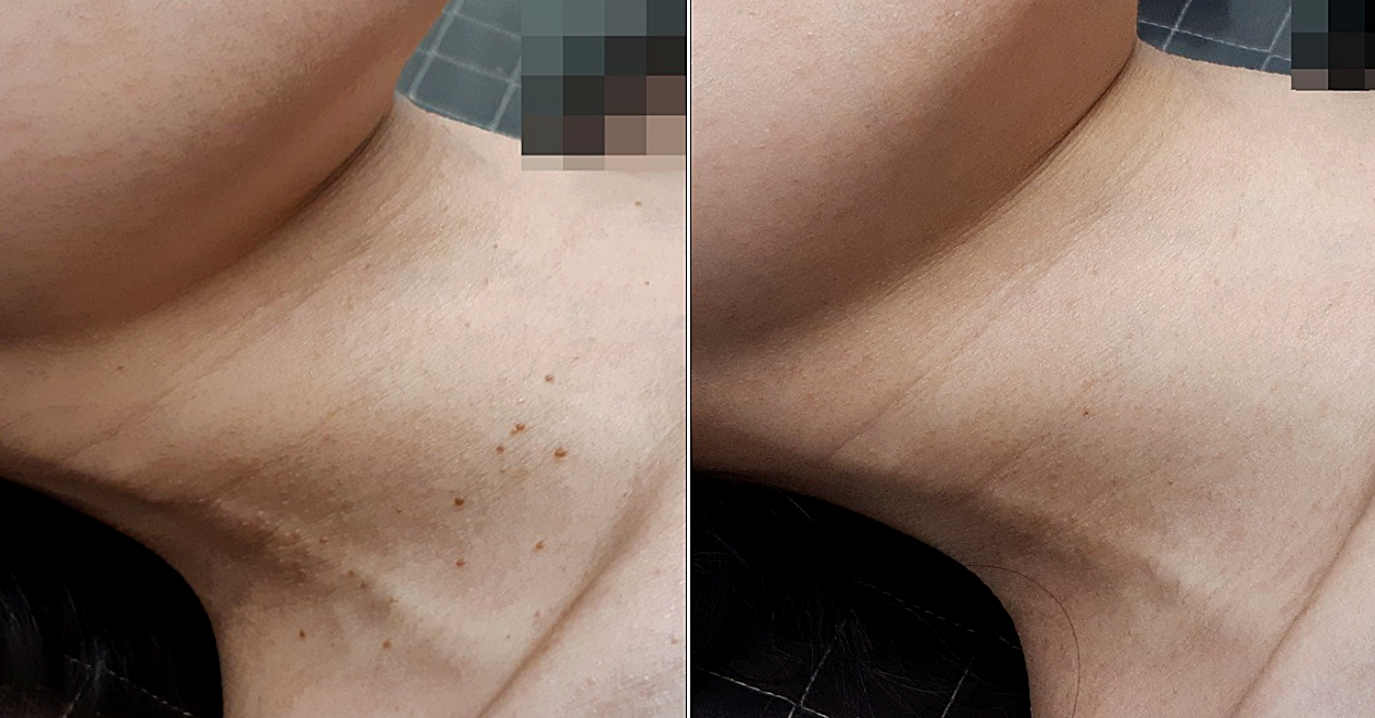 광주 편평사마귀 치료 사진, 목에서 쇄골 부위에 좁쌀처럼 나 있던 편평사마귀가 치료 후 깨끗하게 사라진 모습