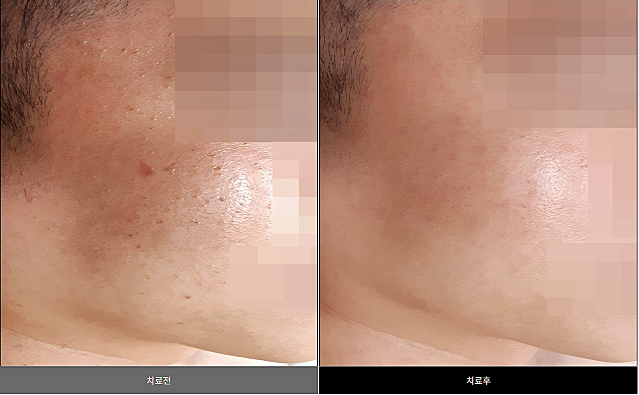 광주 편평사마귀 치료 전후 비교, 볼에서 턱으로 이어지는 부위의 붉은 병변이 치료 후 정리된 모습