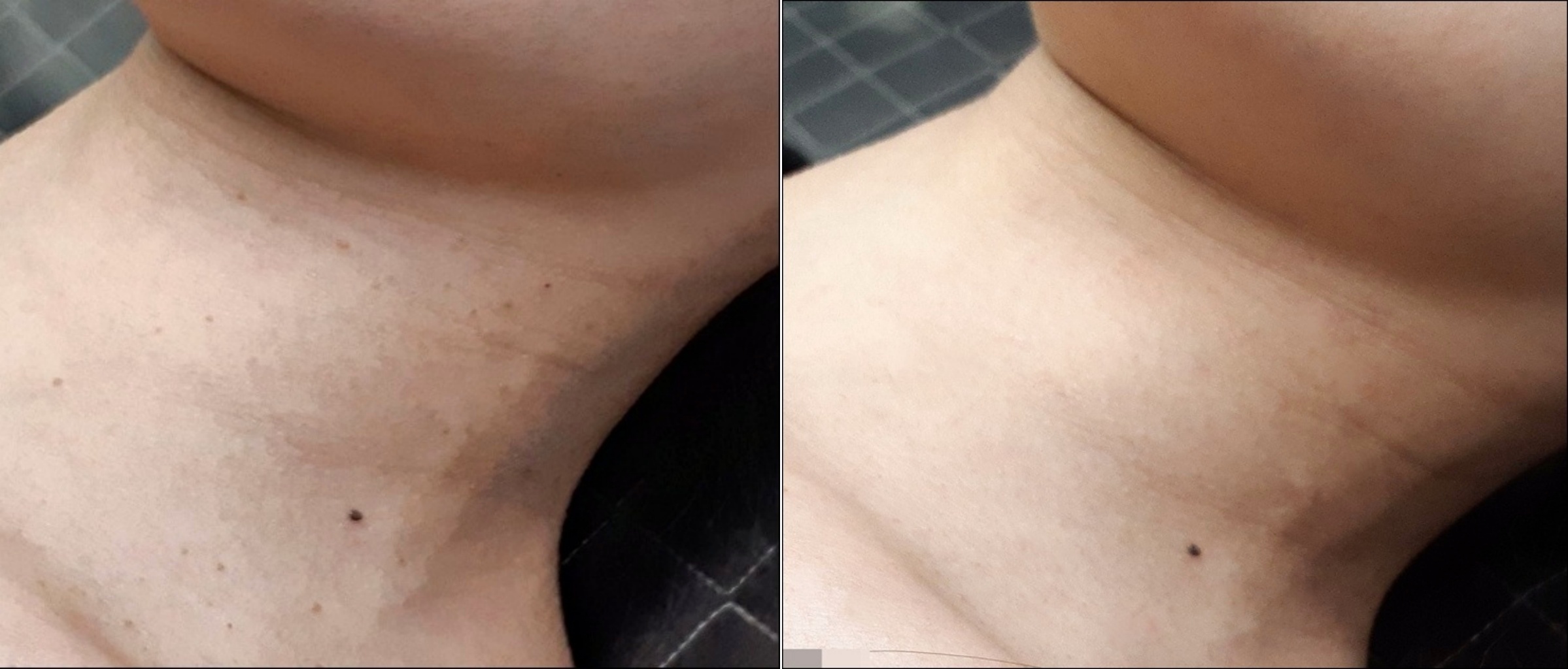 쥐젖 제거 치료 전후 목 아래 부위 비교 사진
