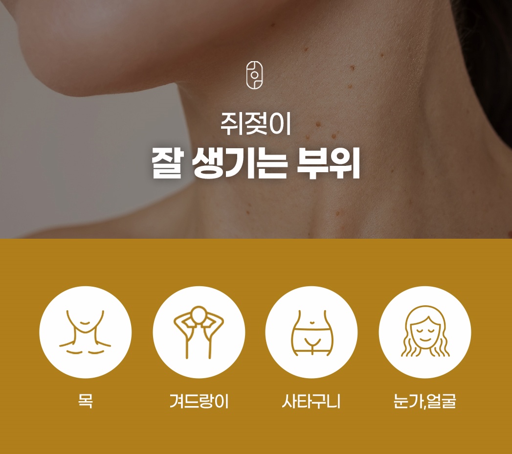 쥐젖 잘 생기는 부위는?