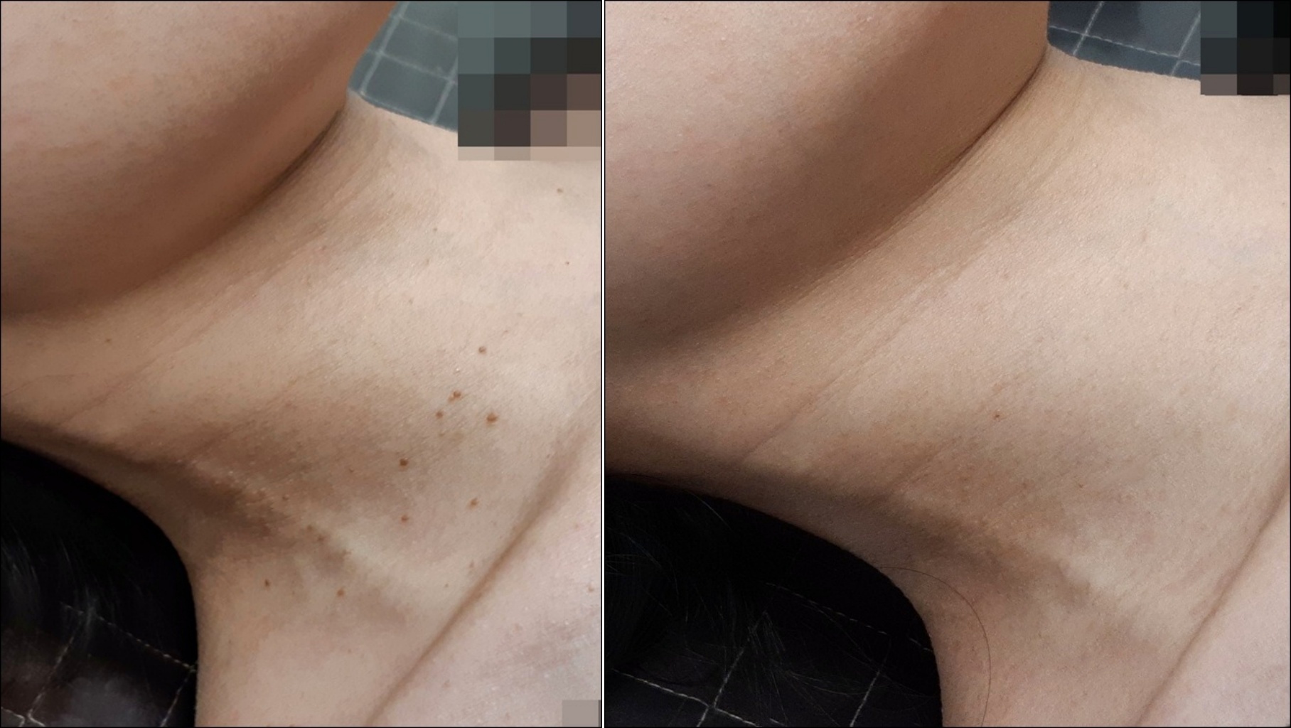 	쥐젖 제거 치료 전후 목 부위 비교 사진