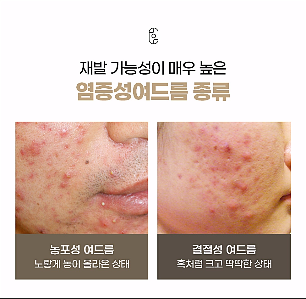 농포성 여드름은 노랗게 농이 올라온 상태, 결절성 여드름은 혹처럼 크고 딱딱한 상태로 재발 가능성이 높은 염증성 여드름이라는 설명