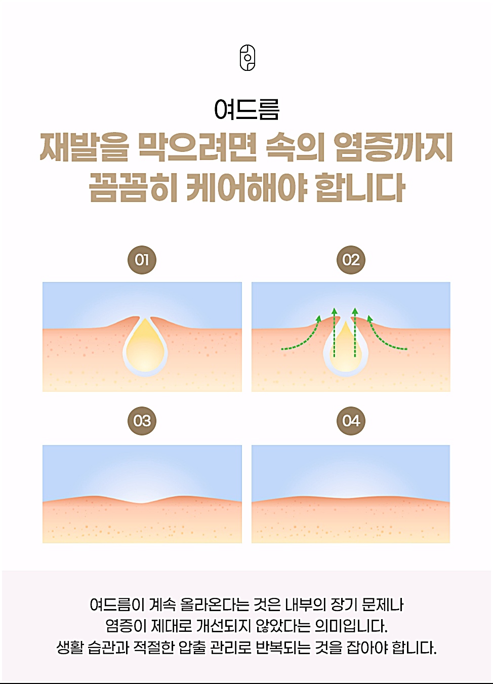 광주여드름 피부과가 말하는 여드름이 계속 올라오는 것은 속의 염증이 제대로 개선되지 않았다는 의미