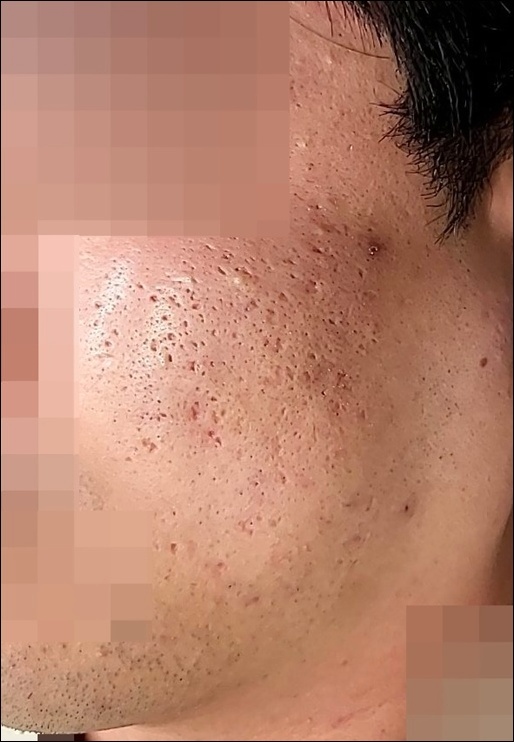 깊은 여드름 패인 흉터 시술 전 측면 얼굴 피부 상태