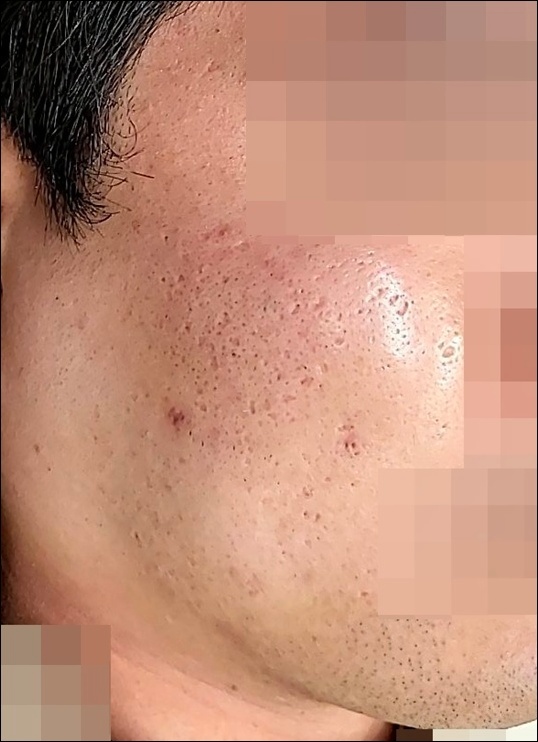 여드름 흉터 트랜스테라피 시술 전 볼 피부 상태