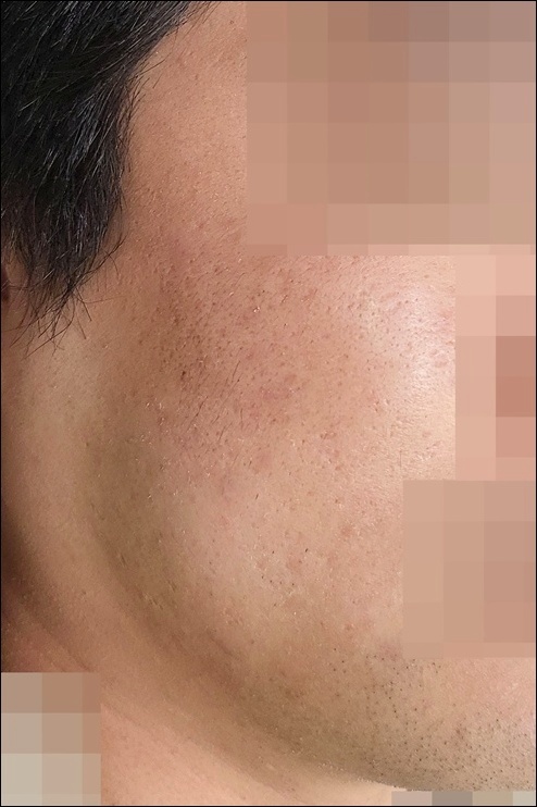 여드름 흉터 트랜스테라피 시술 후 개선된 볼 피부 상태