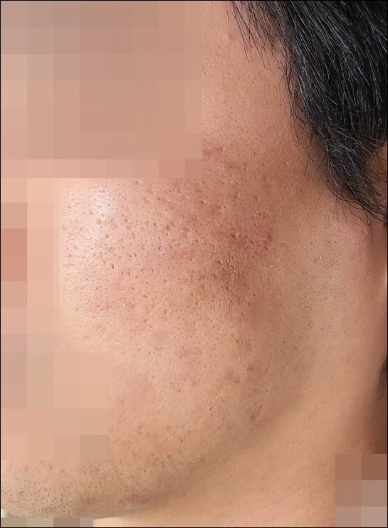 깊은 여드름 패인 흉터 시술 후 매끄러워진 측면 얼굴 피부 상태