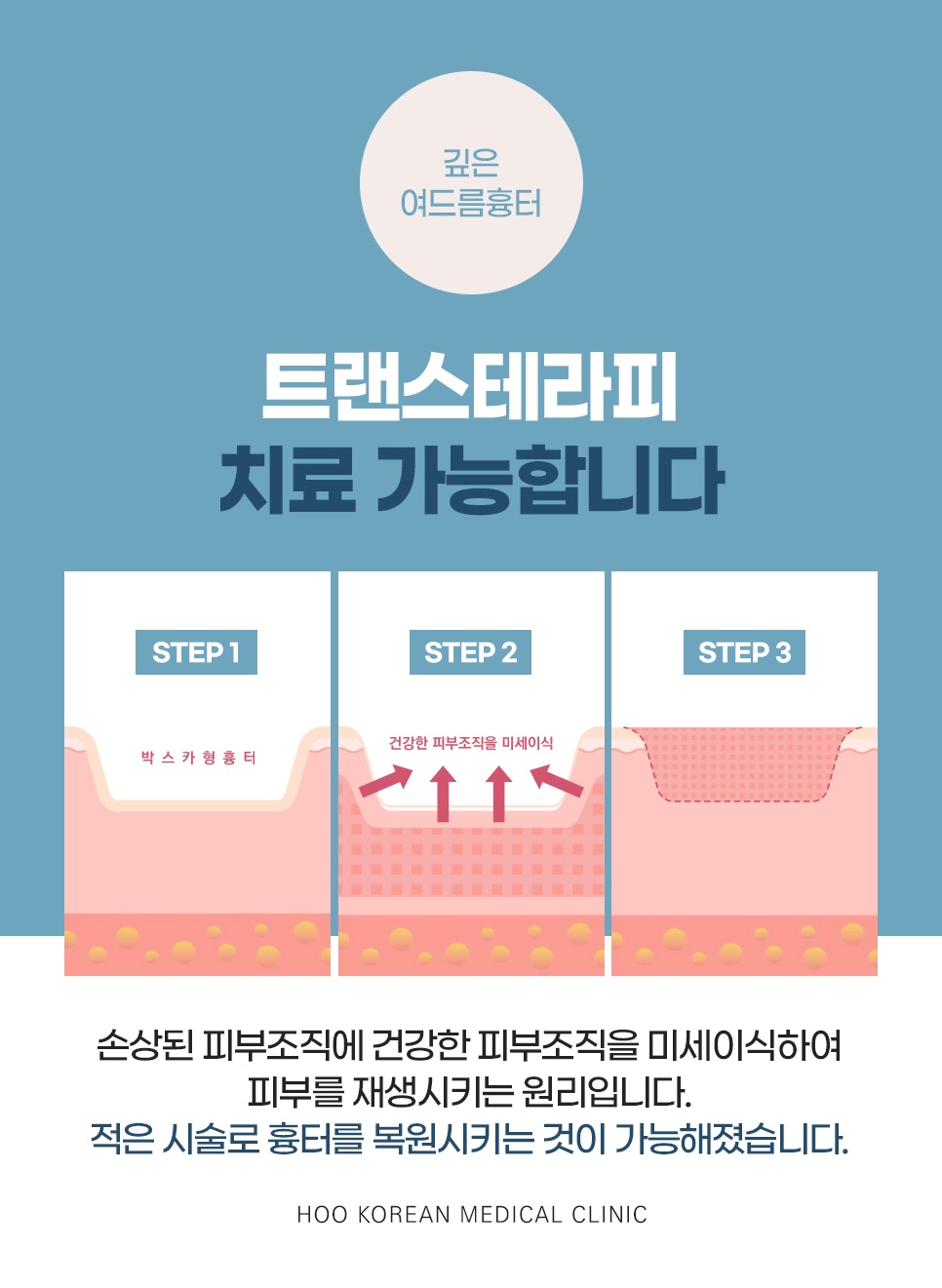 깊은 여드름 흉터 트랜스테라피 치료 원리 및 복원 단계 안내