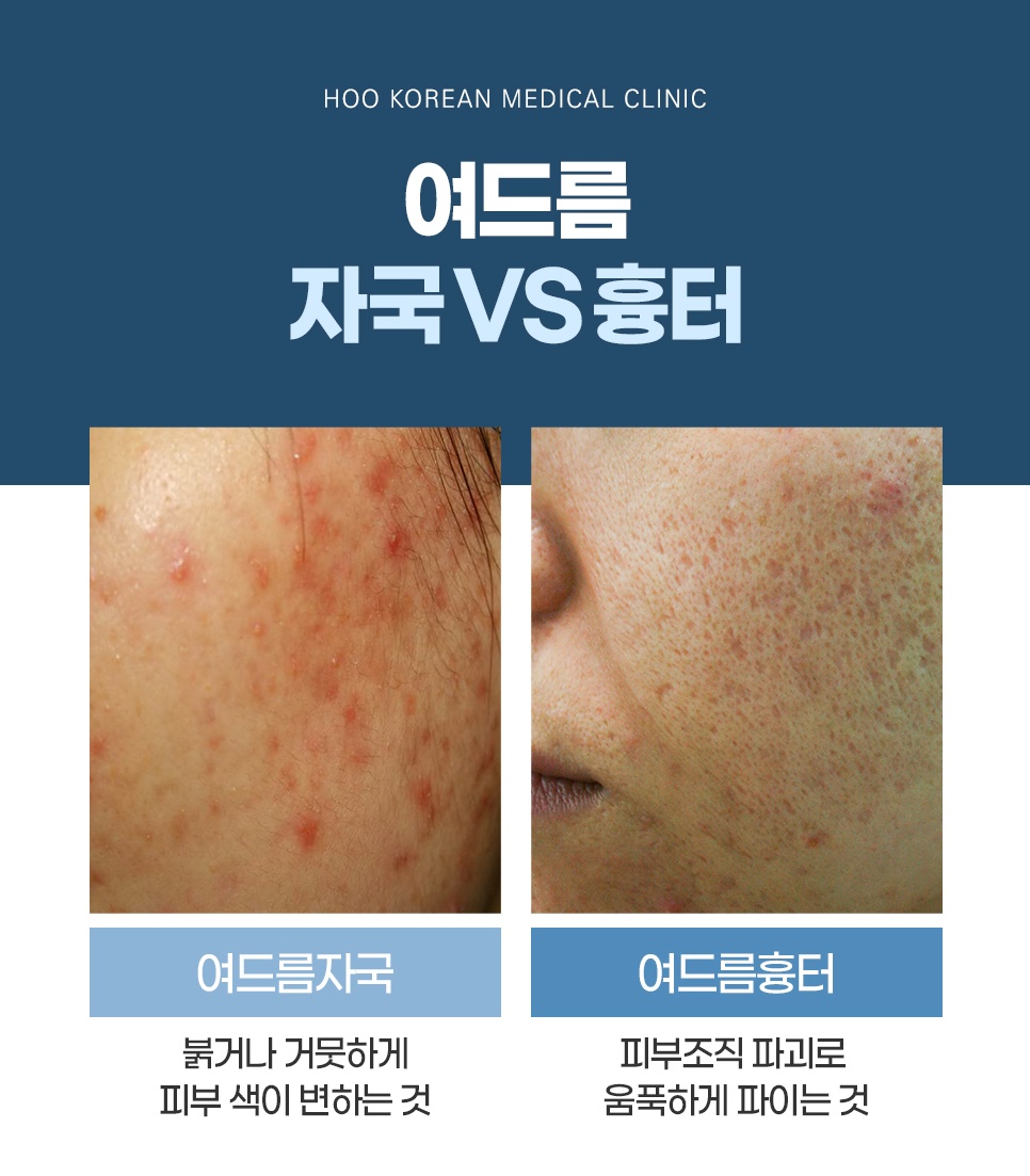 여드름 자국과 여드름 흉터 차이 비교 안내 이미지 (후한의원 광주점)