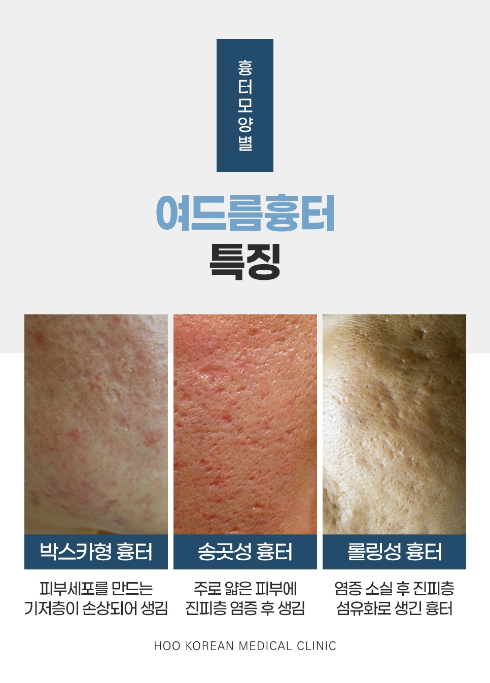 여드름 흉터 모양별 특징 - 박스카형 흉터, 송곳성 흉터, 롤링성 흉터 비교