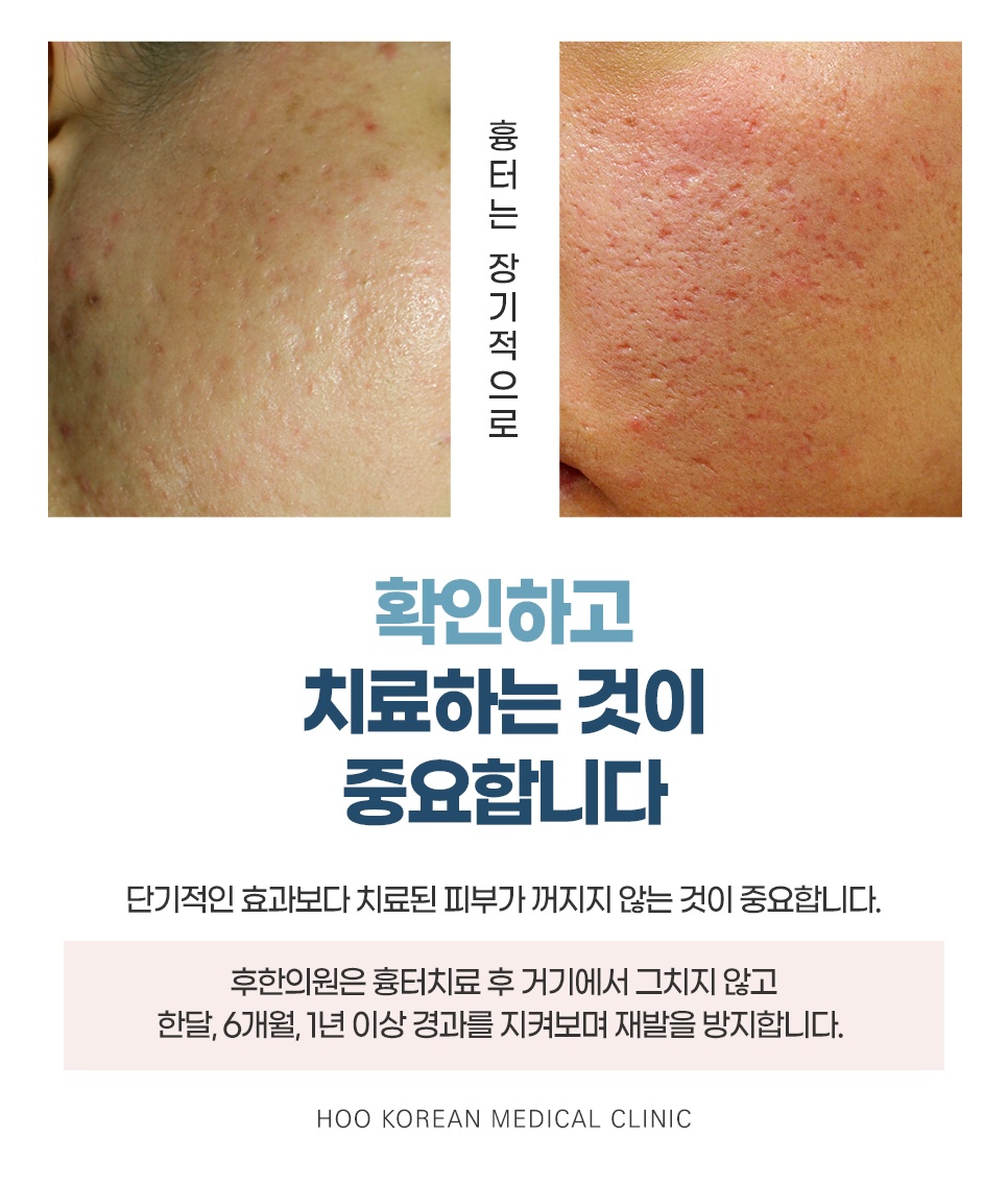 여드름 흉터 장기적인 경과 관찰 및 재발 방지 치료 중요성 안내