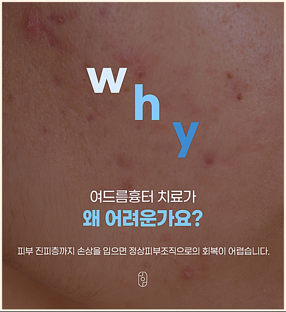 여드름흉터 치료 왜 어려운가요? 치료가 어려운 이유 설명