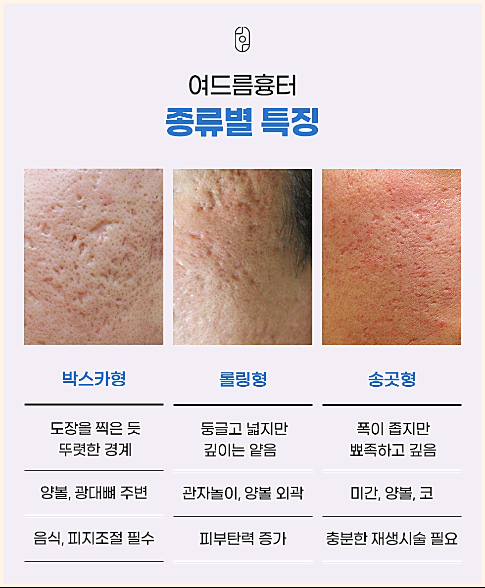 여드름흉터 종류별 특징(박스카형, 롤링형, 송곳형) 안내
