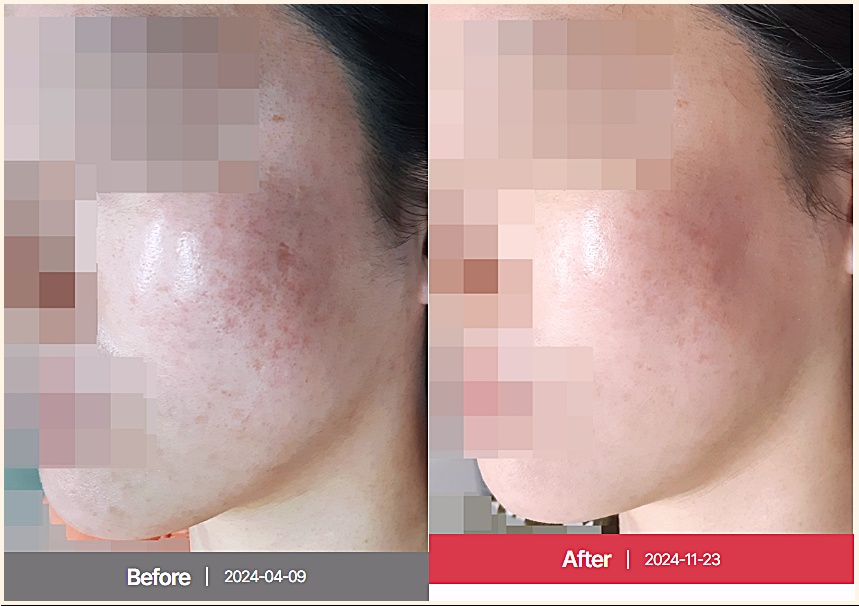 광주여드름흉터 트랜스테라피 치료 전후 비교 사진