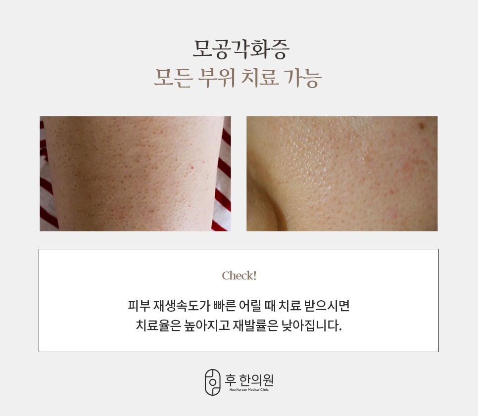 팔다리와 얼굴 등 여러 부위에 나타나는 모공각화증 사례
