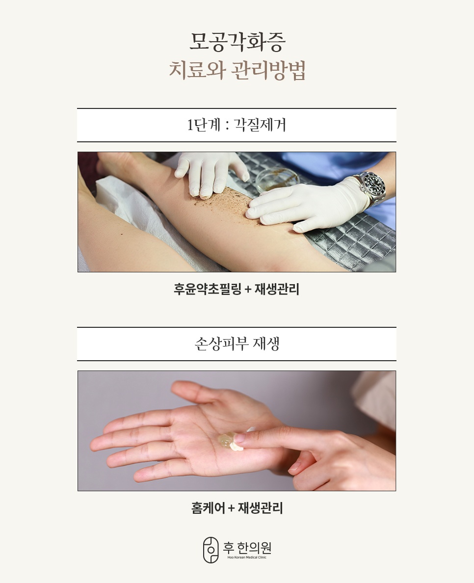 후윤약초필링과 홈케어를 더한 모공각화증 단계별 관리법
