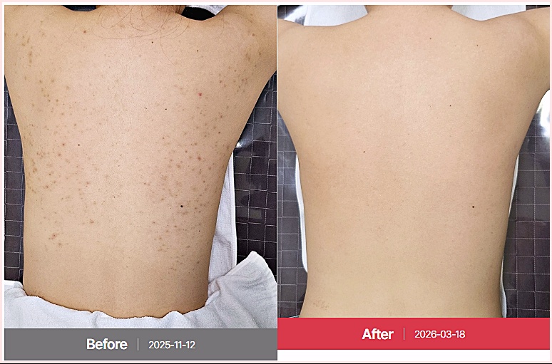 광주등드름 치료 전후 비교 사진, 등 색소침착과 붉은 병변 개선 전후
