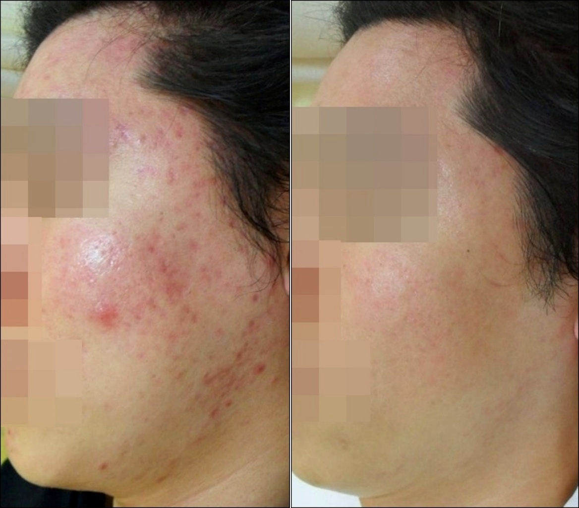 볼 여드름 및 피부 붉은기 치료 전후 비교 사진