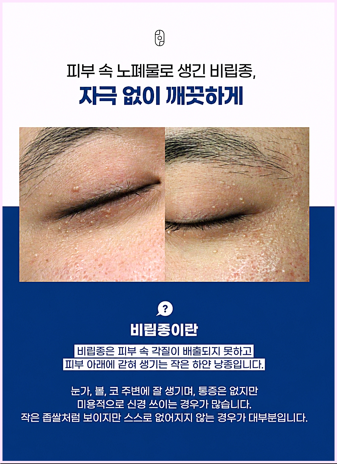 광주비립종제거 눈가에 올라온 하얀 비립종과 비립종 설명