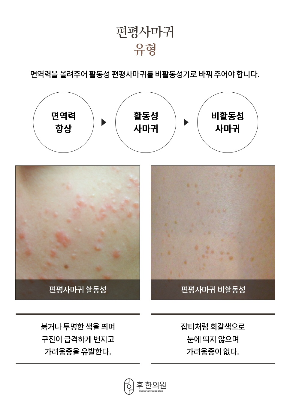 면역력 향상으로 붉은 활동성 사마귀를 회갈색 비활동성으로 전환하는 과정과 두 가지 피부 사진