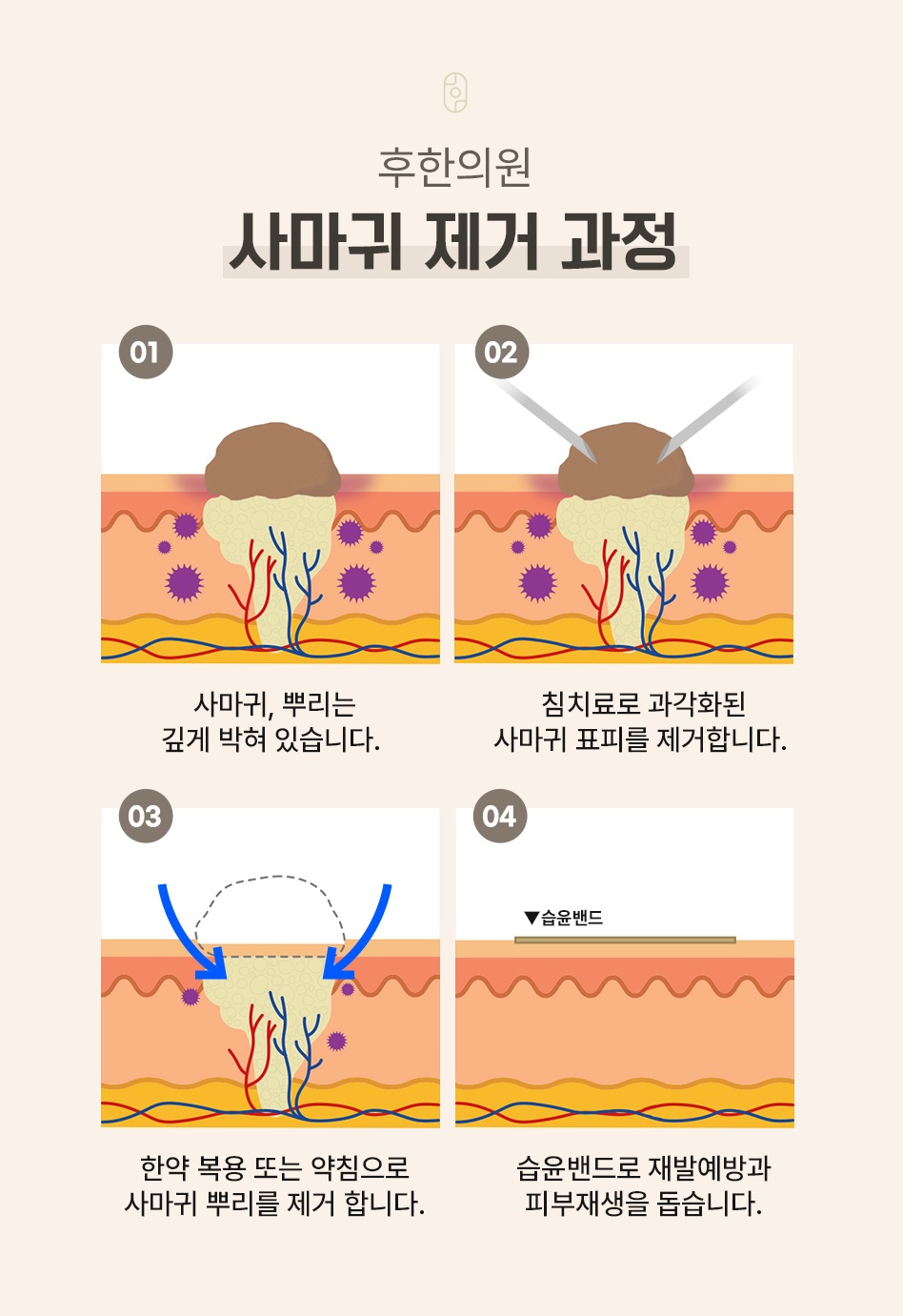 뿌리 깊은 사마귀의 표피를 제거하고 약침과 습윤밴드로 재생을 돕는 4단계 단면도
