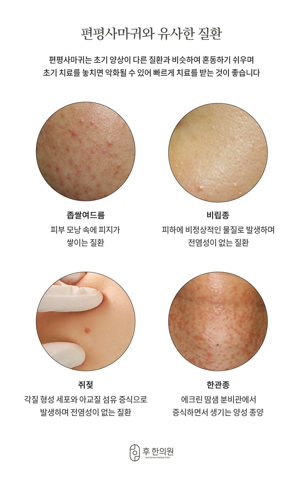 좁쌀여드름, 비립종, 쥐젖, 한관종과 편평사마귀를 확대 사진으로 비교한 감별 안내