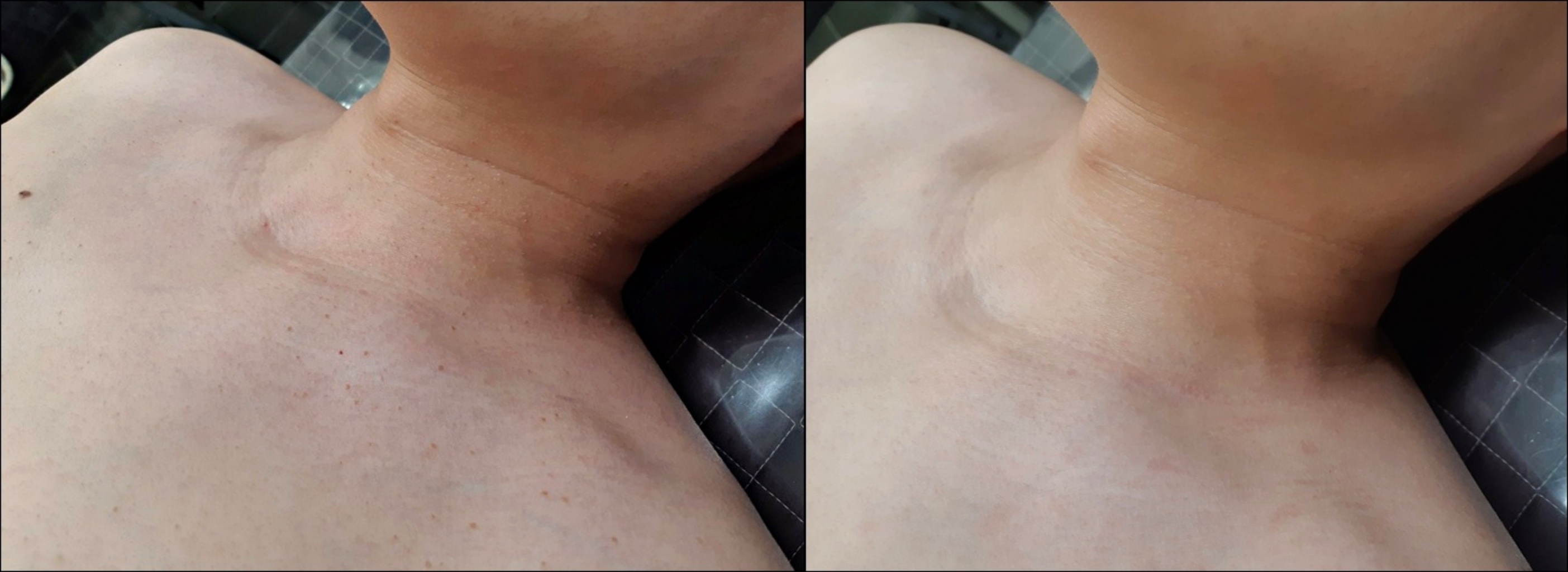 목과 쇄골 주변에 깨알처럼 퍼진 갈색 편평사마귀의 치료 전 모습