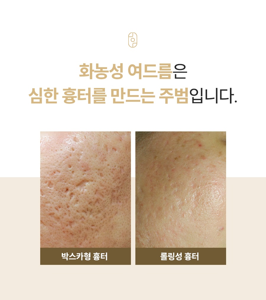 구멍 모양으로 깊게 패인 박스카형과 물결처럼 울퉁불퉁한 롤링성 흉터 사진
