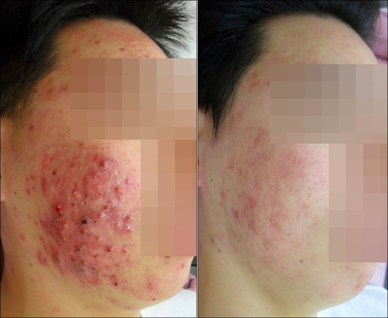 뺨 전체에 붉은 농포가 몰려 있던 모습이 옅은 붉은기로 줄어든 전후 옆모습
