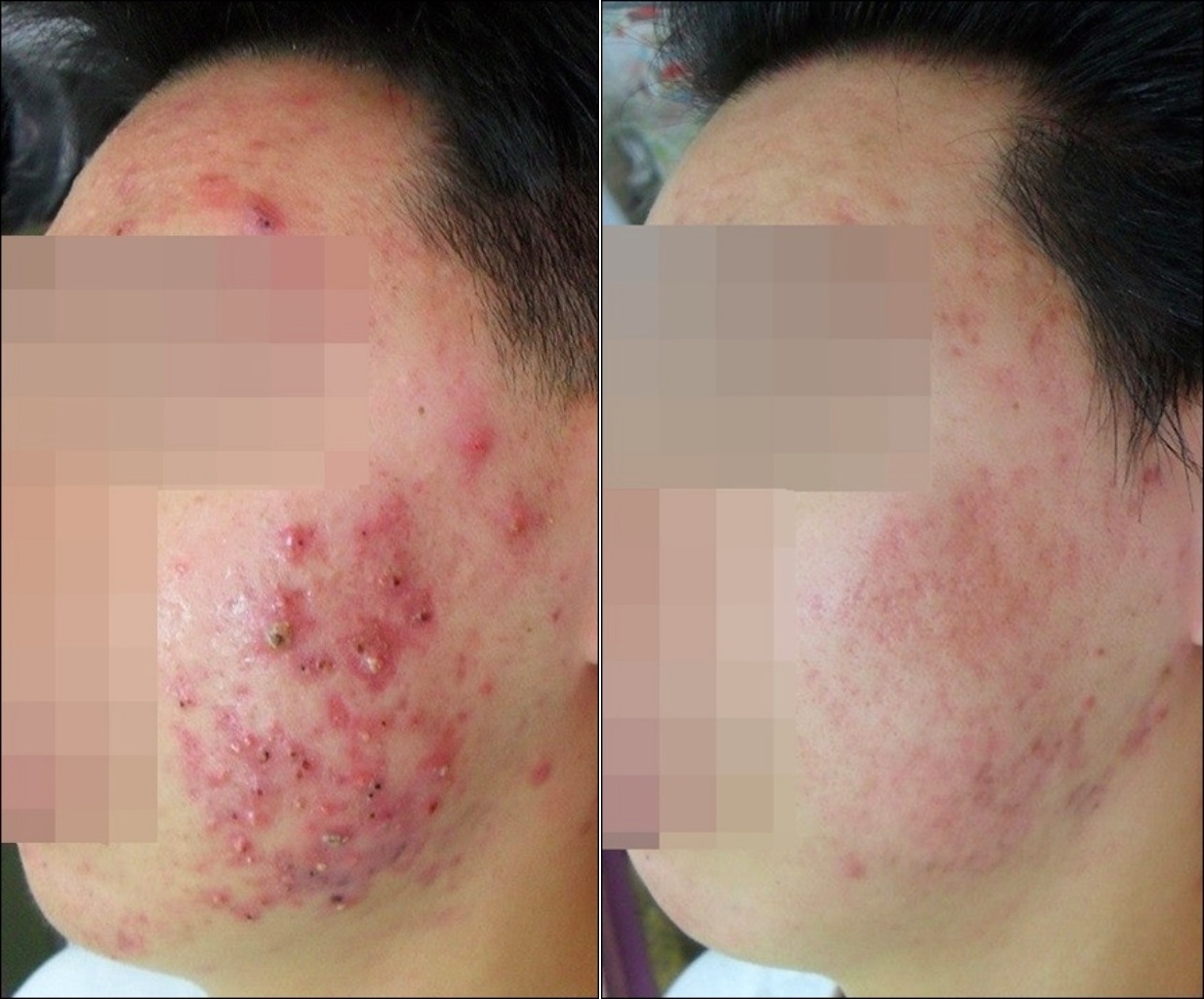 턱선까지 이어진 화농성 염증이 잦아든 측면 전후 사진