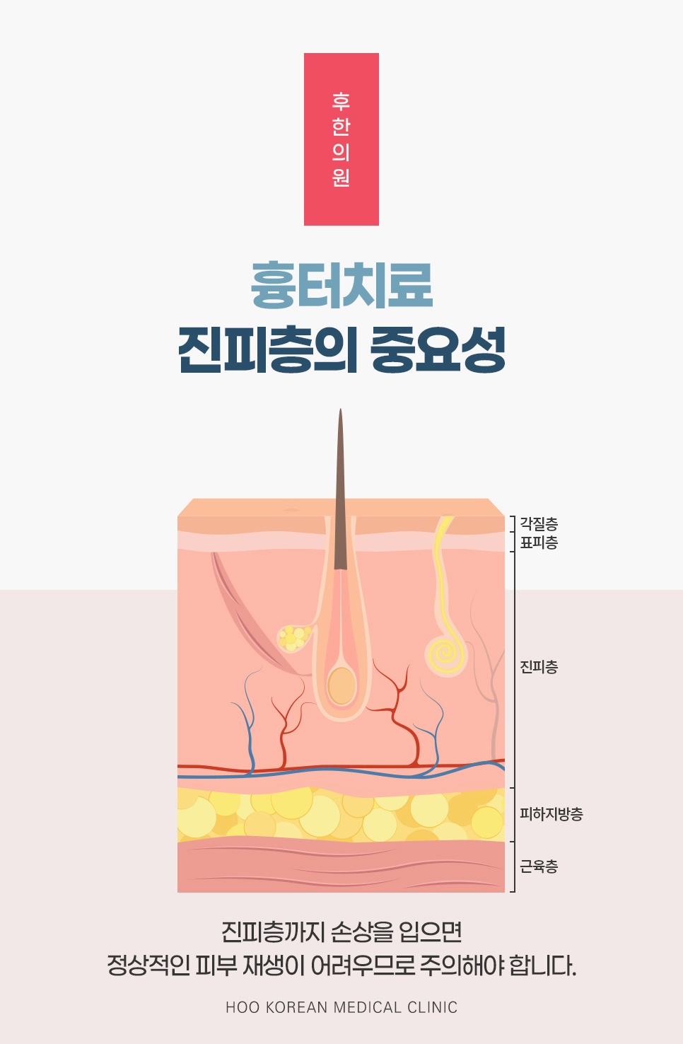 각질층부터 근육층까지 층별로 나눈 피부 단면에서 진피 손상이 재생을 어렵게 하는 이유