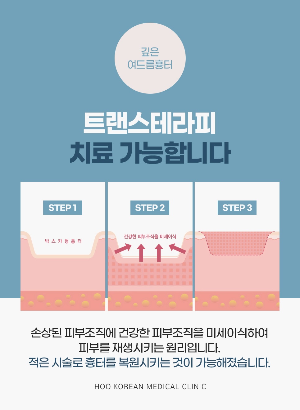 파인 박스카형 흉터에 건강한 피부조직을 미세 이식해 메워가는 트랜스테라피 3단계