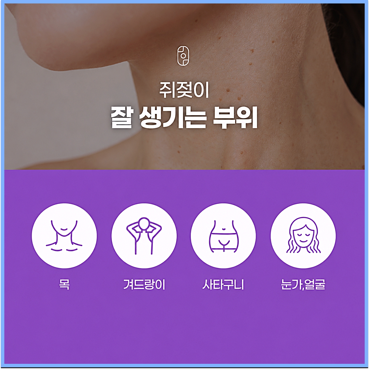 쥐젖이 잘 생기는 부위는 목, 겨드랑이, 사타구니, 눈가