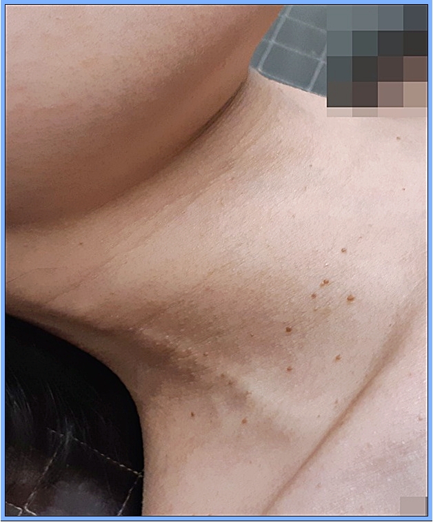 광주쥐젖치료 시술 전 목주름을 따라 작은 쥐젖과 갈색 반점이 있는 모습