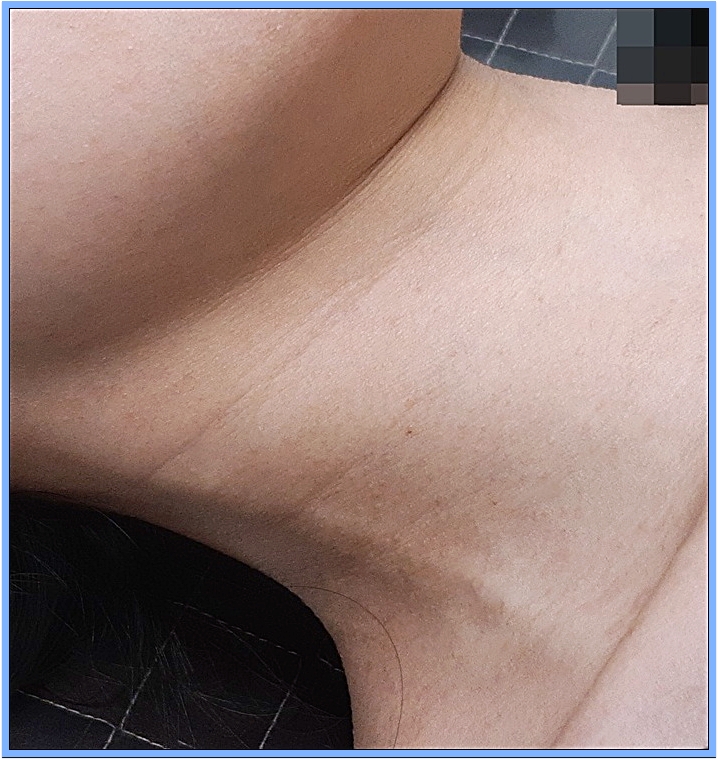 광주쥐젖치료 시술 후 쥐젖과 반점이 제거되어 목주름 라인이 정돈된 모습