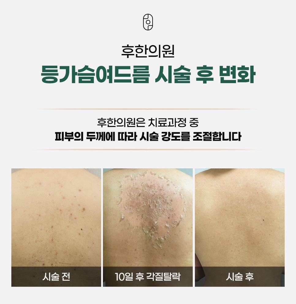 등가슴여드름 시술 전, 10일 후 각질탈락, 시술 후 변화를 피부 두께에 따라 시술 강도를 조절해 보여주는 전후 안내