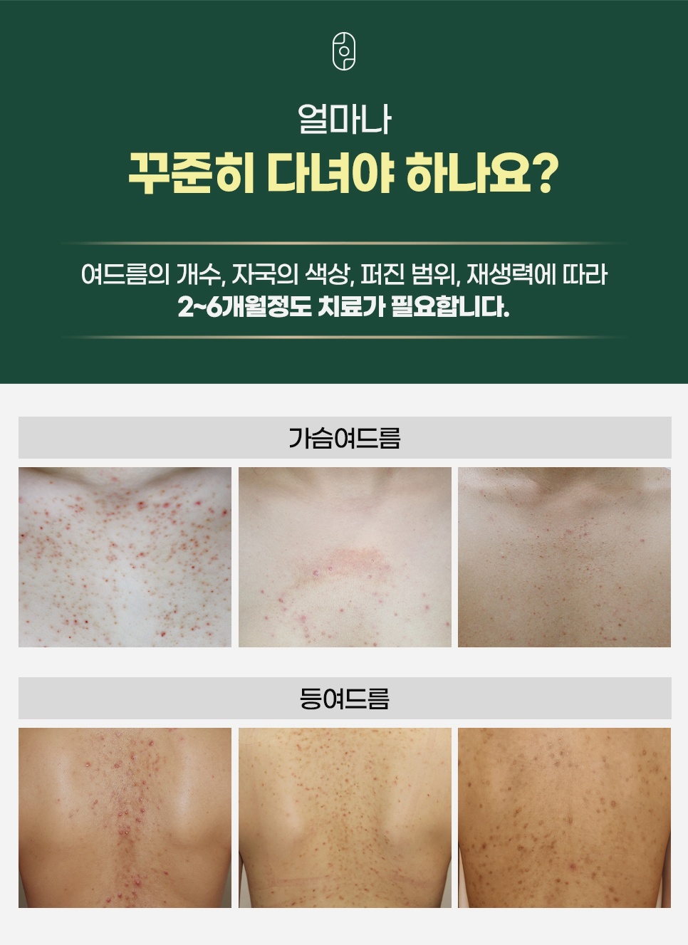 여드름 개수와 퍼진 범위, 재생력에 따라 2~6개월 치료가 필요한 가슴·등여드름 치료 기간 안내